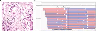 Case Report: Benefits of a NSCLC Patient With EGFR A289G/F287_G288insHA cis Mutations From Immunotherapy in Combination With Antiangiogenesis and Chemotherapy and Sequential Treatment of EGFR-TKI